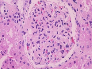 Targeted Drug First to Show Real Promise in IgA Nephropathy